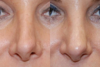 Non-Surgical Rhinoplasty with Silikon-1000 before 164130