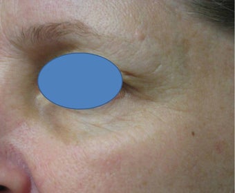 TCA Chemical Peel after 76521