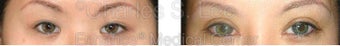 Blepharoplasty before 427722