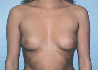 Breast Augmentation - Small B Cup to Small D Cup before 297500