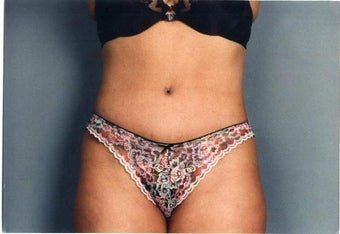 Tummy Tuck after 215126