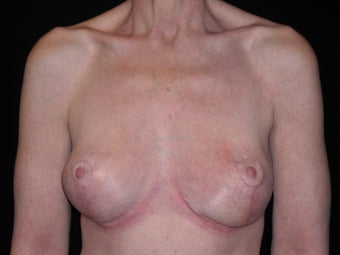 Breast lift (mastopexy) after 231596