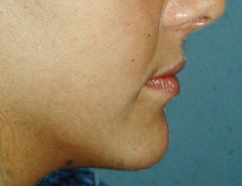 Chin Augmentation after 251515