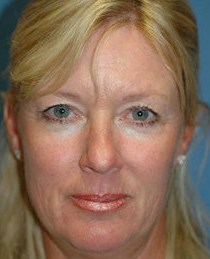 Mini Lift, Eyelid and Brow Lift Surgery before 324009