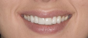 porcelain veneers after 363976