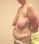 Breast Reduction Surgery and Tummy Tuck before 630993