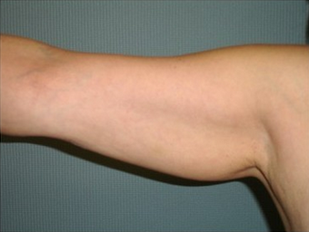 Brachioplasty (Arm Lift) before 171913