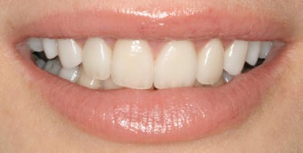 Dental implants, all porcelain restorations, gum re-contouring after 503152