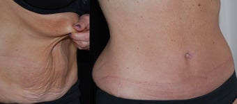 Full Tummy Tuck after 478949
