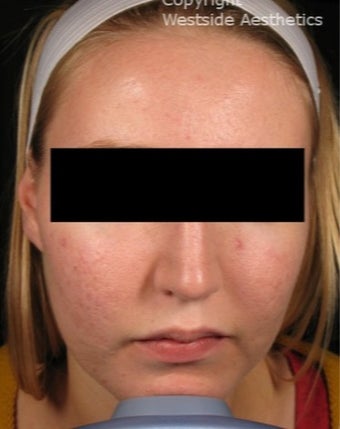 CO2 for Acne Scars before 3075693