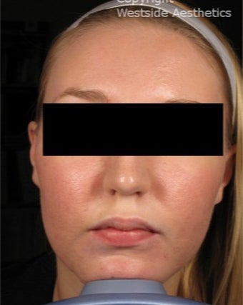 CO2 for Acne Scars after 3075693