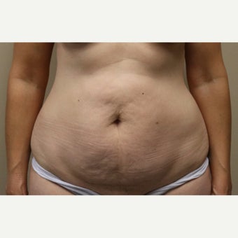 45-54 year old woman treated with Tummy Tuck before 2556403