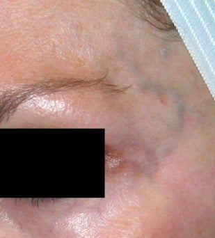 Laser facial vein treatment before 374363