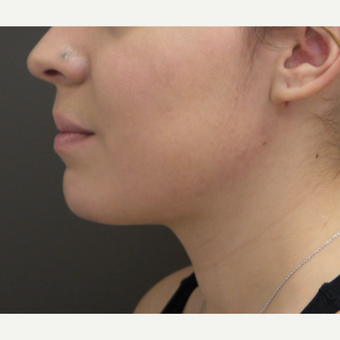 18-24 year old woman treated with Chin Liposuction after 3704046