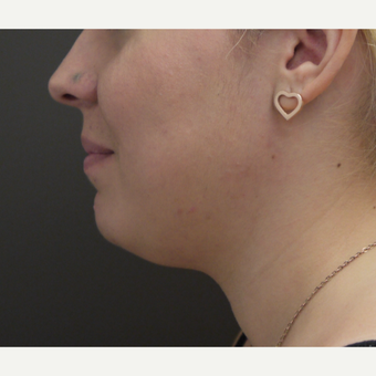 18-24 year old woman treated with Chin Liposuction before 3704046