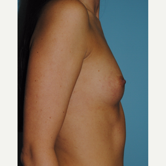 30 year old with 300 cc silicone gel implants before 3163530
