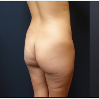 25-34 year old woman treated with Butt Implants before 3731696