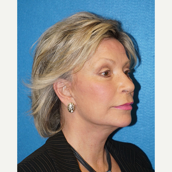 63 year old woman treated with Facelift after 3576617