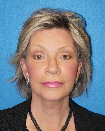 63 year old woman treated with Facelift 3576617