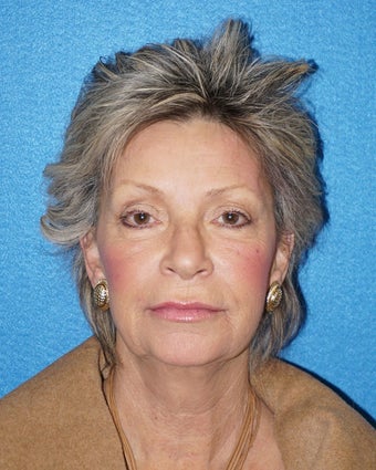 63 year old woman treated with Facelift 3576617