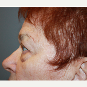 65-74 year old woman treated with Eyelid Surgery before 3709179