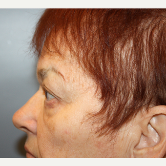 65-74 year old woman treated with Eyelid Surgery after 3709179