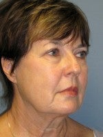 55-64 year old woman treated with Neck Lift before 3103928