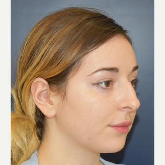 18-24 year old woman treated with Rhinoplasty before 3341295