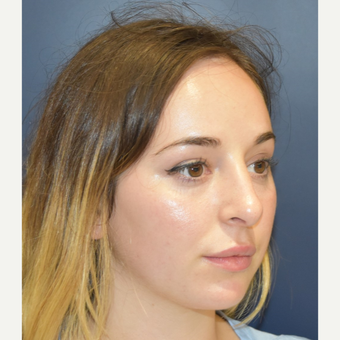 18-24 year old woman treated with Rhinoplasty after 3341295
