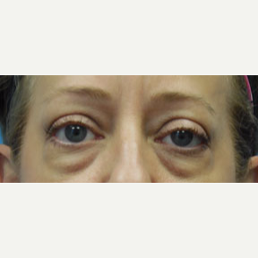 54 year old woman treated with Eyelid Surgery before 3141028