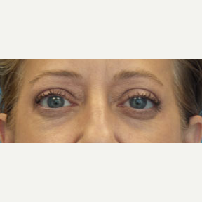 54 year old woman treated with Eyelid Surgery after 3141028