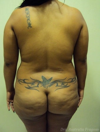 30 year old female treated for Brazilian Butt Lift before 967838