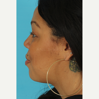 25-34 year old woman treated with Rhinoplasty after 3628936