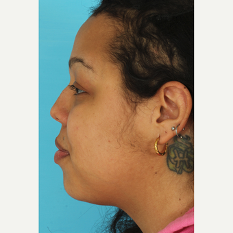 25-34 year old woman treated with Rhinoplasty before 3628936