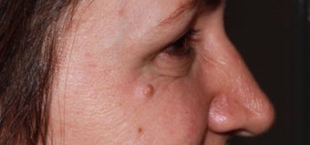 45-54 year old woman treated with Injectable Fillers after 3364502