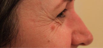 45-54 year old woman treated with Injectable Fillers before 3364502