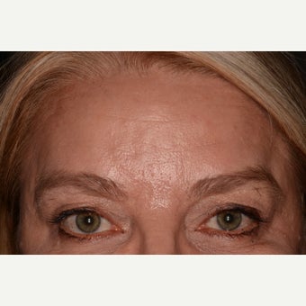 Botox and Belotero for eye lift and forehead lines after 1545108