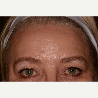 Botox and Belotero for eye lift and forehead lines before 1545108