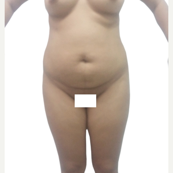 35-44 year old woman treated with Tummy Tuck before 3358754