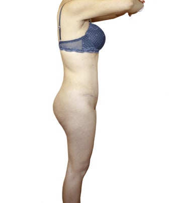 35-44 year old woman treated with Tummy Tuck 3358754