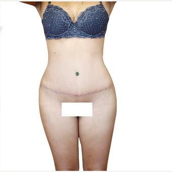 35-44 year old woman treated with Tummy Tuck after 3358754