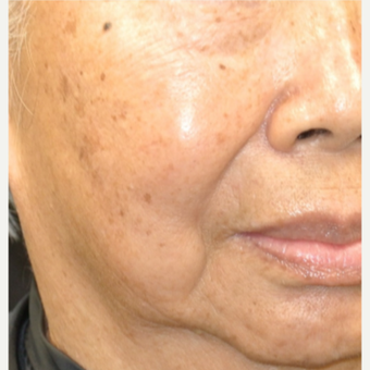 75 and up year old woman treated with IPL before 3350867