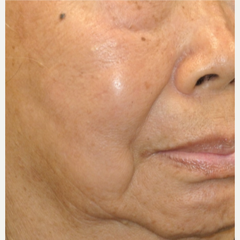 75 and up year old woman treated with IPL after 3350867