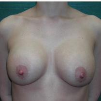 18-24 year old woman treated with Breast Implant Revision before 3376631