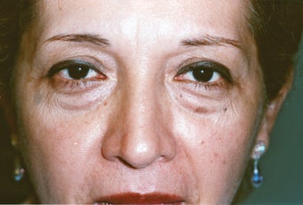 Lower Blepharoplasty & Laser Skin Resurfacing before 1002861