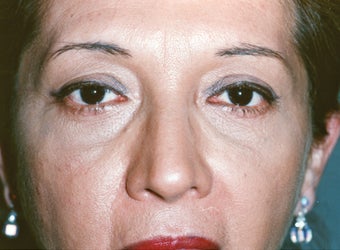 Lower Blepharoplasty & Laser Skin Resurfacing after 1002861