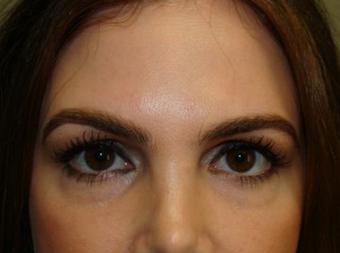 Eyelid Surgery before 962118