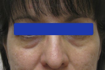 Undereye dark circles treated with filler before 821653