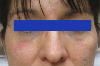 Undereye dark circles treated with filler after 821653