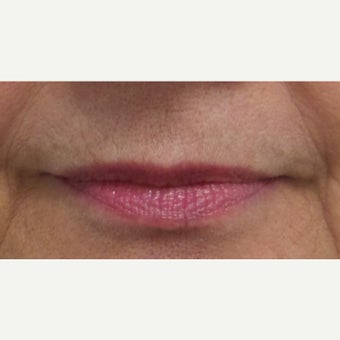 55-64 year old woman treated with Restylane Silk Lip Augmentation before 1704612